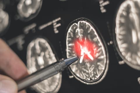 Alzheimer’s gene damages brain vessels, may be reversible: Study