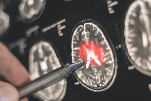 Alzheimer’s gene damages brain vessels, may be reversible: Study