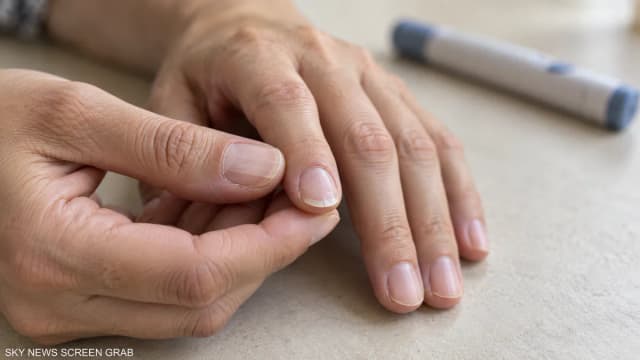 دراسة ترصد تغيرات بالأظافر لدى مستخدمي أدوية السمنة