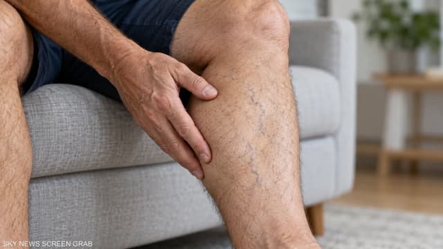 هل وضع ساق فوق أخرى يسبب دوالي الساقين؟