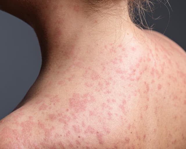 Pennsylvania faces largest measles outbreak in decades as case count rises to 1,000