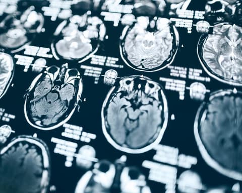 Trump funding cuts may force Alzheimer’s disease study to shut down, affecting 600 aging adults