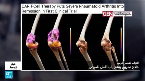التهاب المفاصل المزمن.. علاج تجريبي يفتح باب الأمل للمرضى