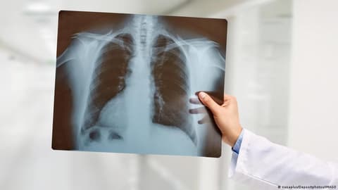 بعد تشخيص البابا ليو الرابع عشر ... سرطان الرئة: أعراض قد تبدو بسيطة لكنها تنذر بمرض خطير